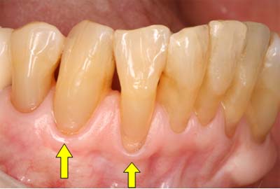 歯肉移植術前.jpg