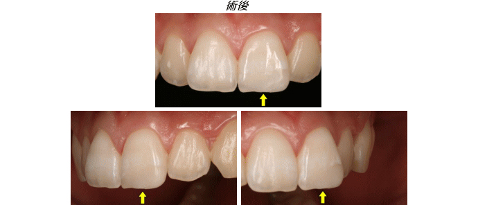 ダイレクトボンディング症例