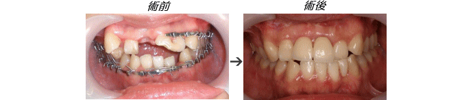 インプラント症例