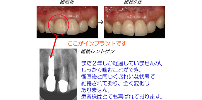 インプラント症例