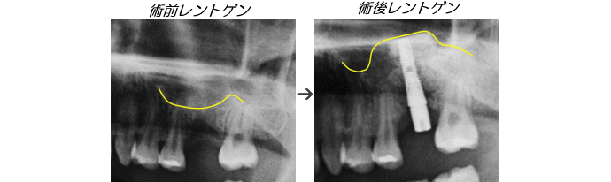 インプラント症例
