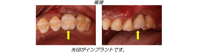 インプラント症例