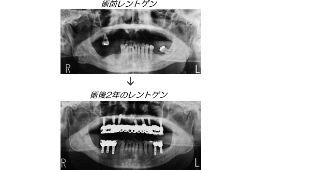 インプラント症例