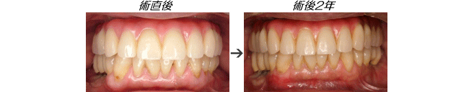 インプラント症例
