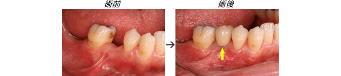 インプラント症例