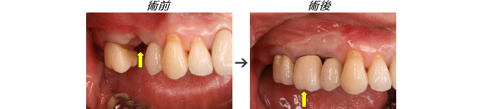インプラント症例