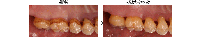 歯周病症例