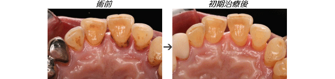 歯周病症例