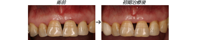 歯周病症例