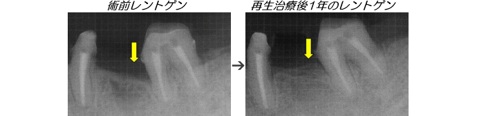 歯周病症例