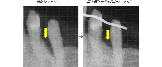 歯周病症例