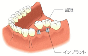 インプラントと他の治療法との比較