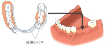 インプラントと他の治療法との比較