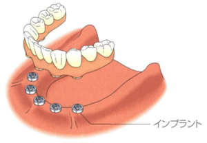 インプラントと他の治療法との比較