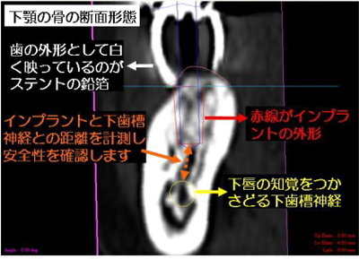 iCATシステム