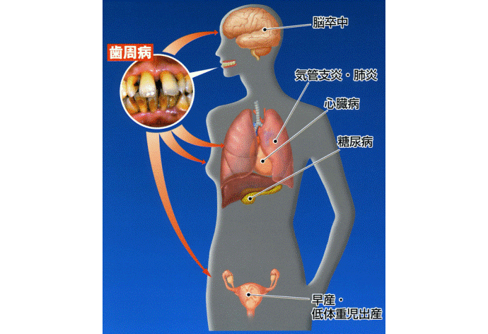 歯周病
